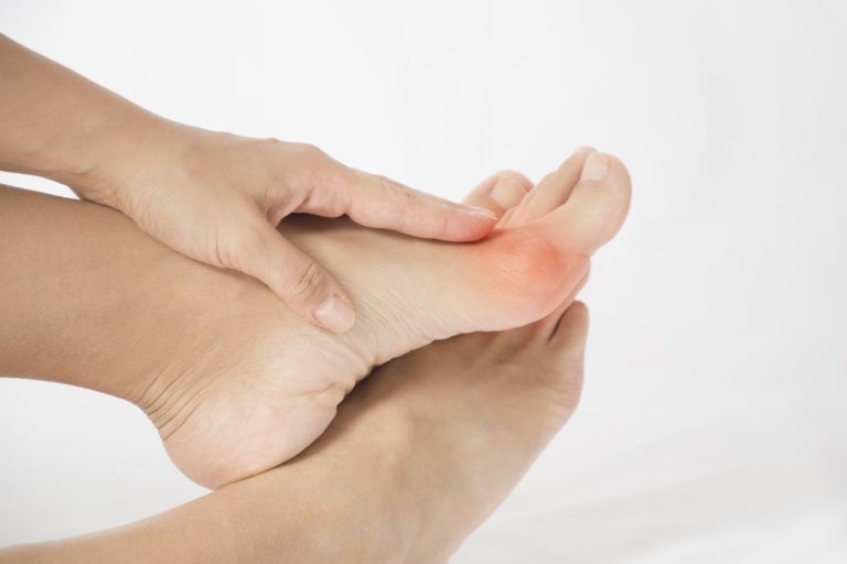 Bunion Treatment at Home – Foot and Ankle Associates